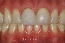 Bonding and Veneer Before