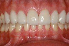 Bonding and Veneer After