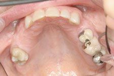 Upper Dental Bridges Before