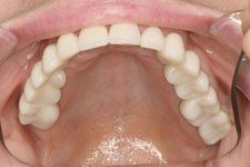 Upper Dental Bridges After