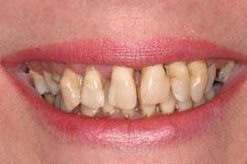 Female Smile Makeover Before