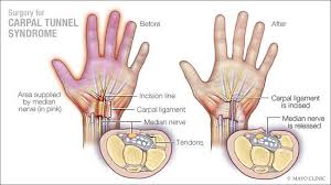 Surgery for Carpal Tunnel Sysndrome