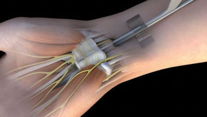 illustration of procedure