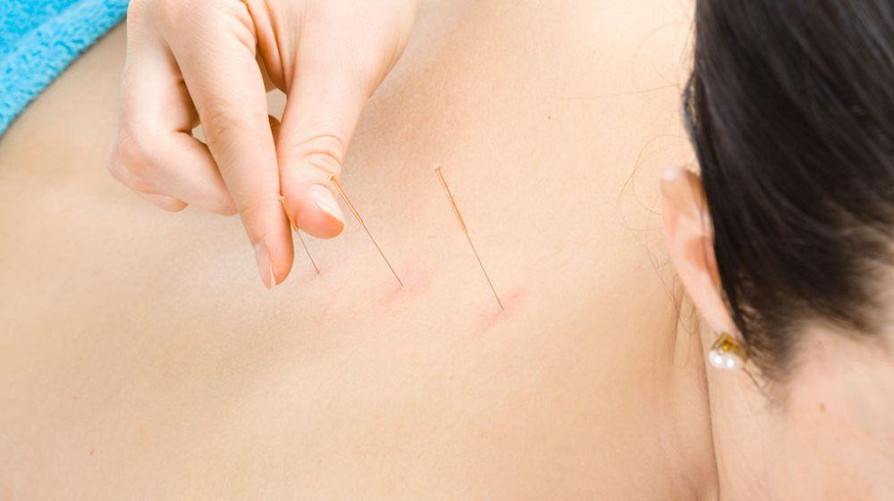 Back Acupuncture