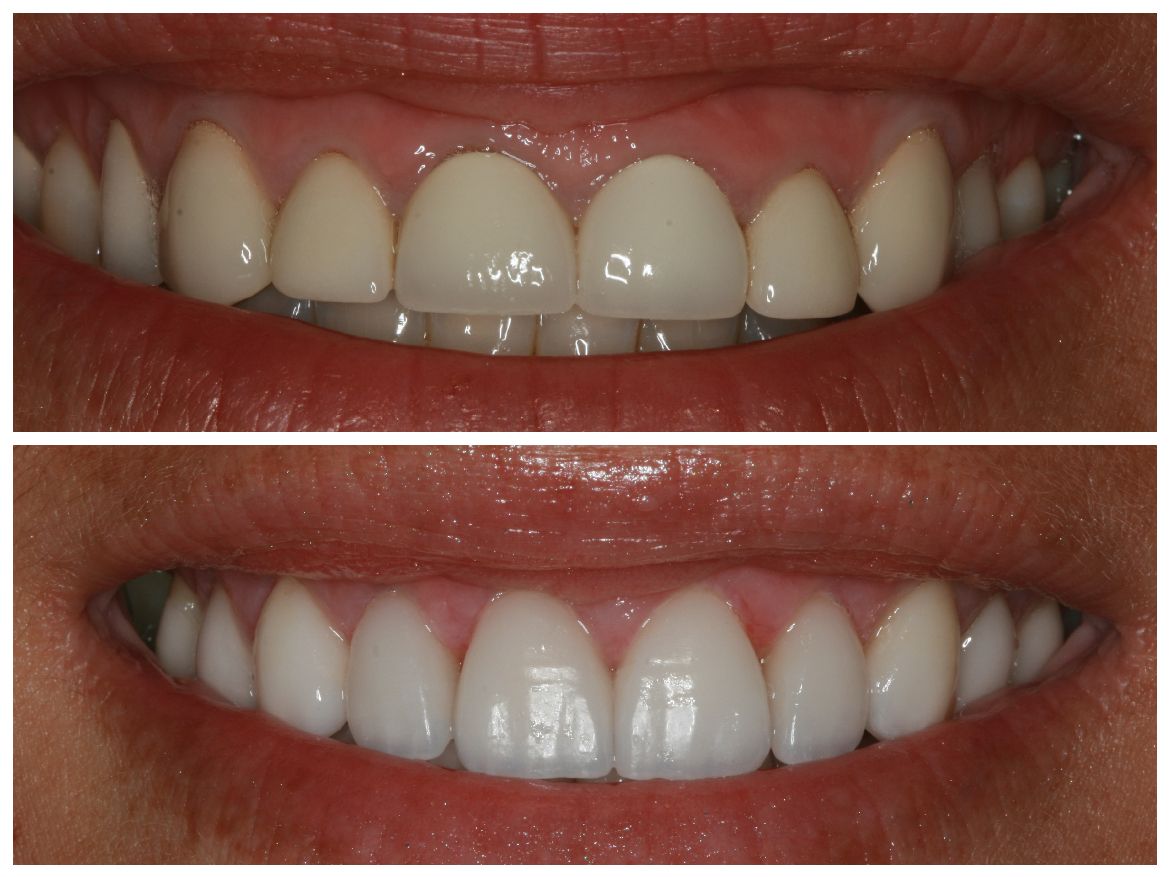 Comparison of teeth before and after cosmetic dental work, showing whiter, aligned teeth.