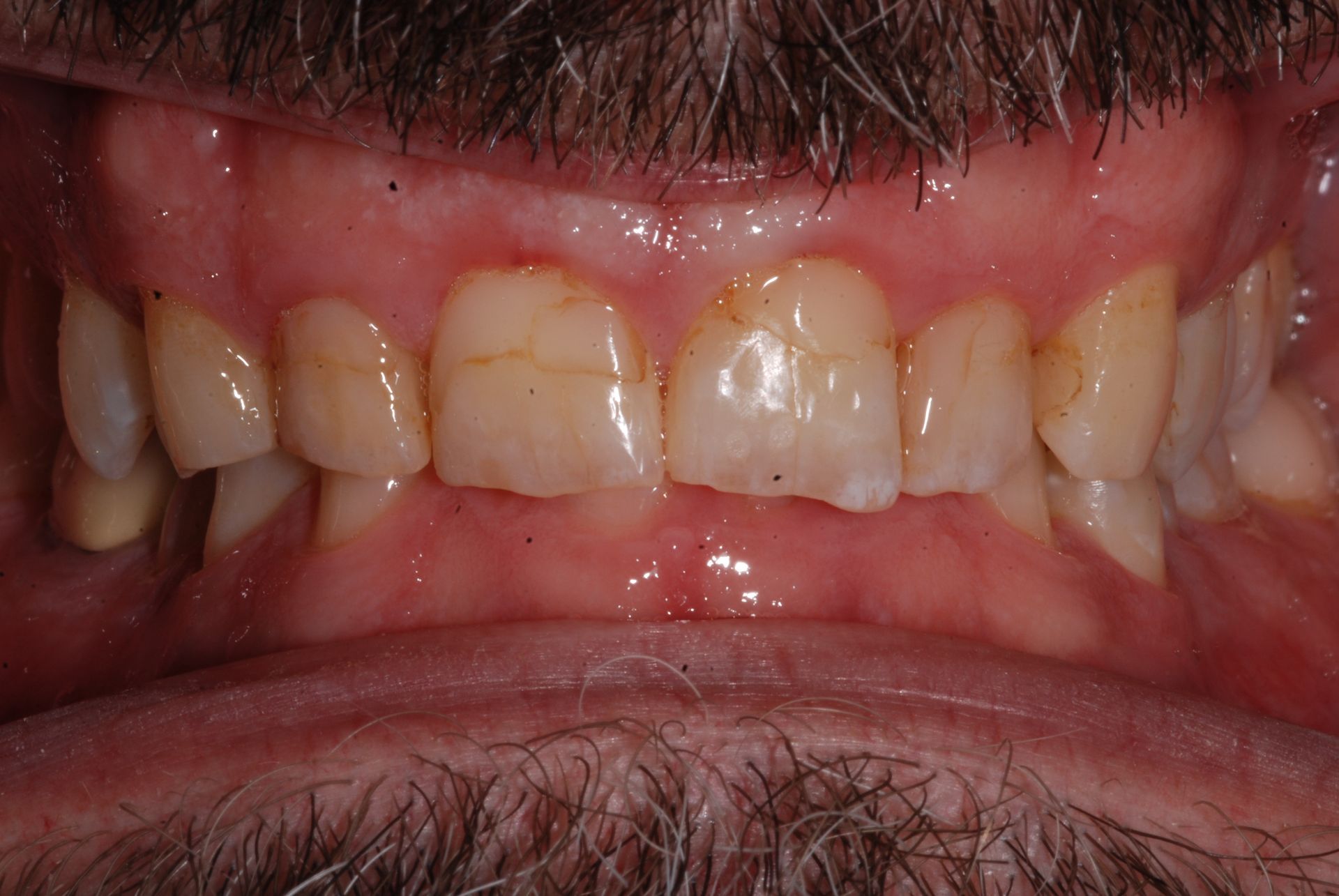 Close-up of a person's teeth showing yellowed enamel and some minor chips or discoloration. Pink gums visible.