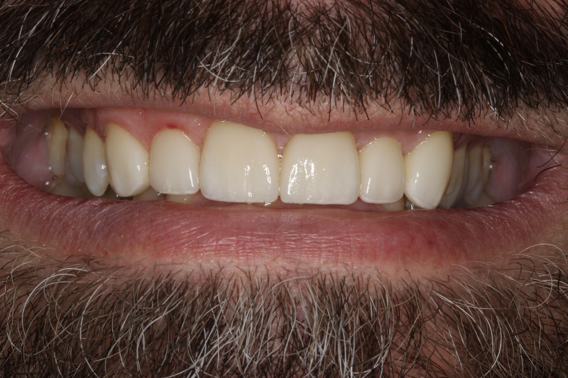 Close-up of a person's smiling mouth showing teeth and gums, framed by a dark beard.