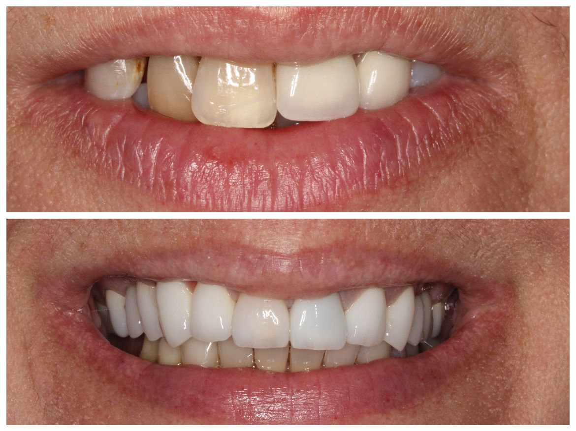 Before-and-after of a person's teeth. Top: chipped tooth. Bottom: full, white smile.