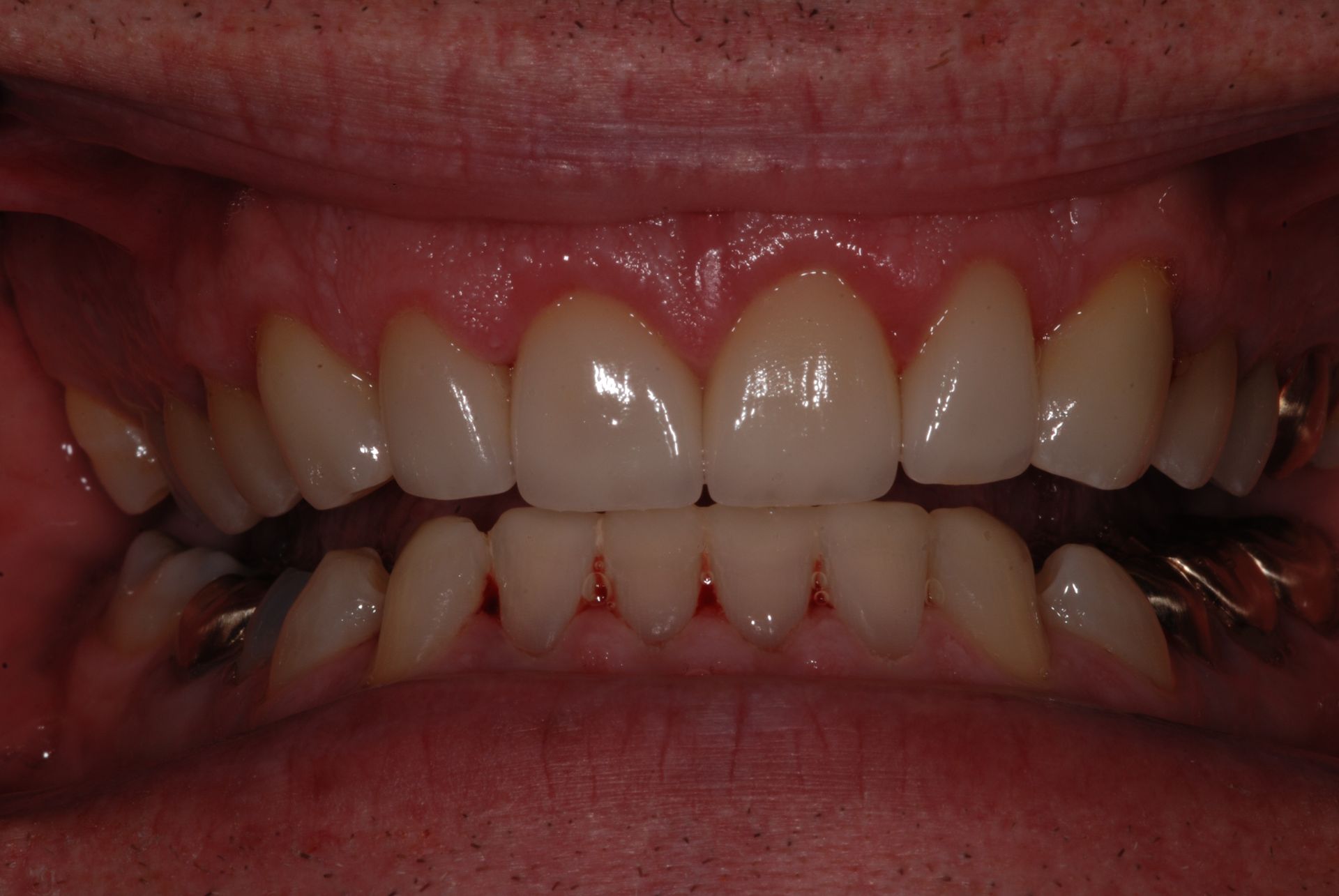 Close-up of teeth, displaying even, white teeth with slight gum recession, and metal retainers on lower teeth.