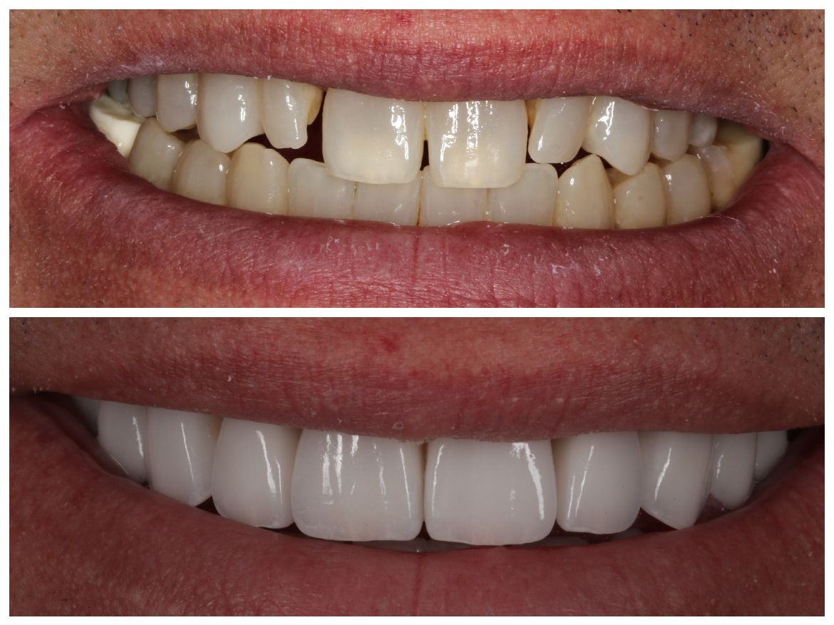 Before and after photos of a person's teeth. Top: broken and discolored teeth. Bottom: bright, aligned teeth.