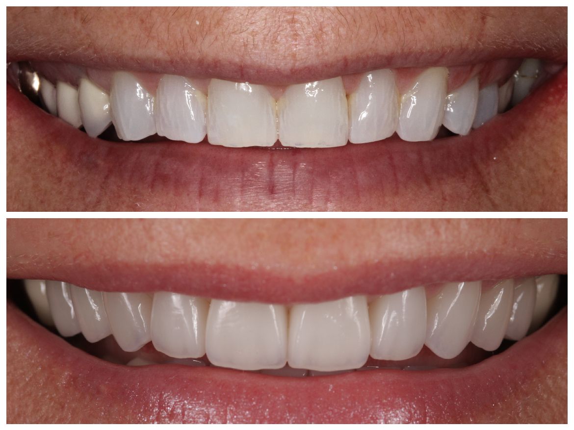 Top and bottom views of a smiling mouth with before and after cosmetic dental work, showing whiter, aligned teeth.