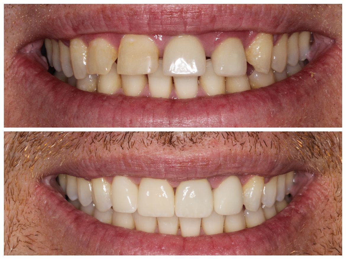 Side-by-side comparison: before and after cosmetic dentistry; showing yellowed, uneven teeth replaced with bright, even ones.