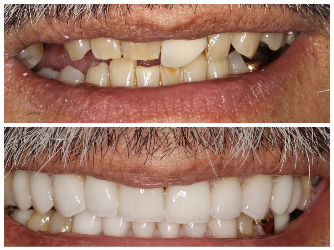 Comparison: Top, damaged teeth; bottom, restored white teeth.