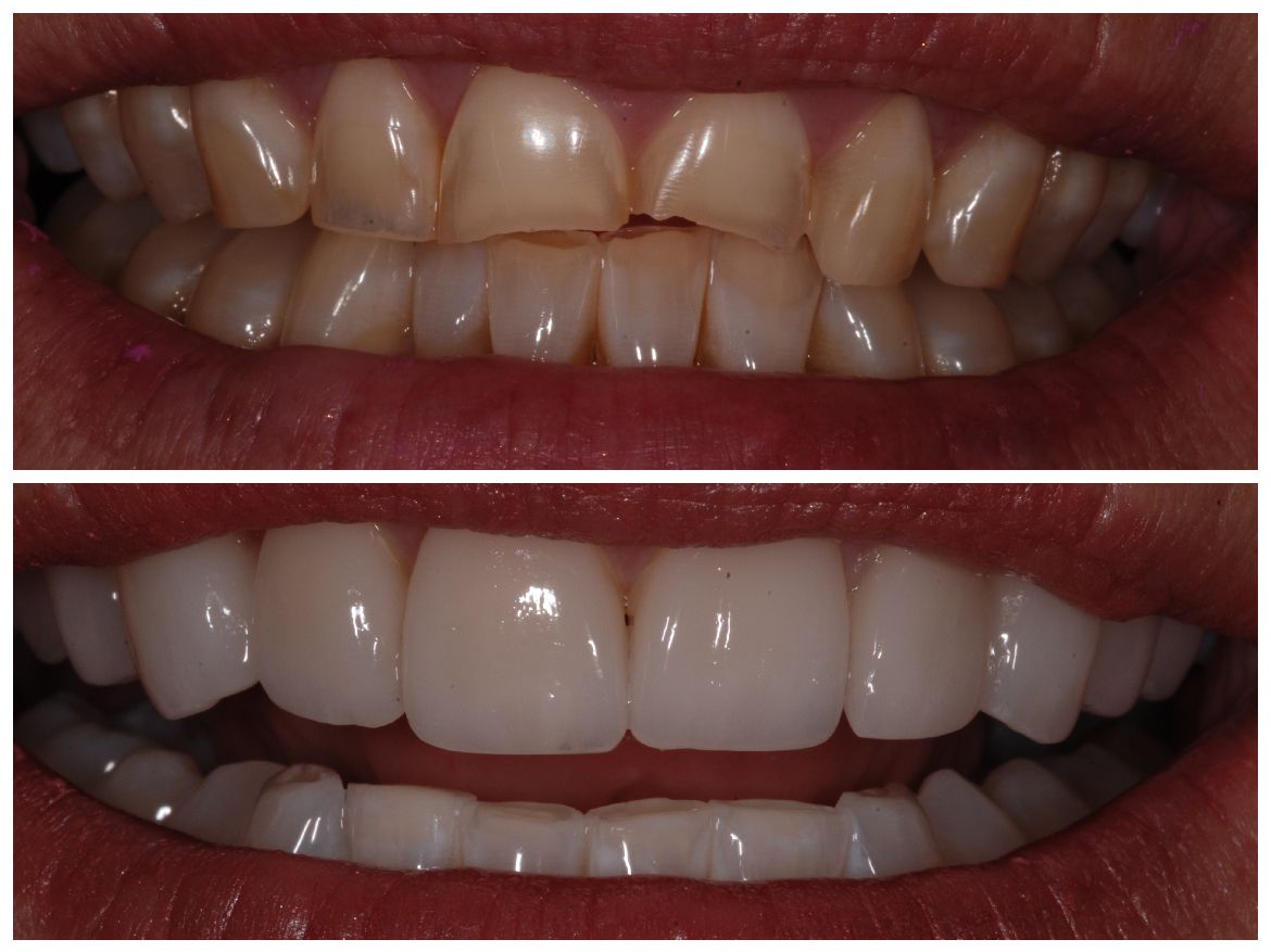 Before and after photos of a person's teeth. Top: damaged teeth. Bottom: bright, restored teeth.