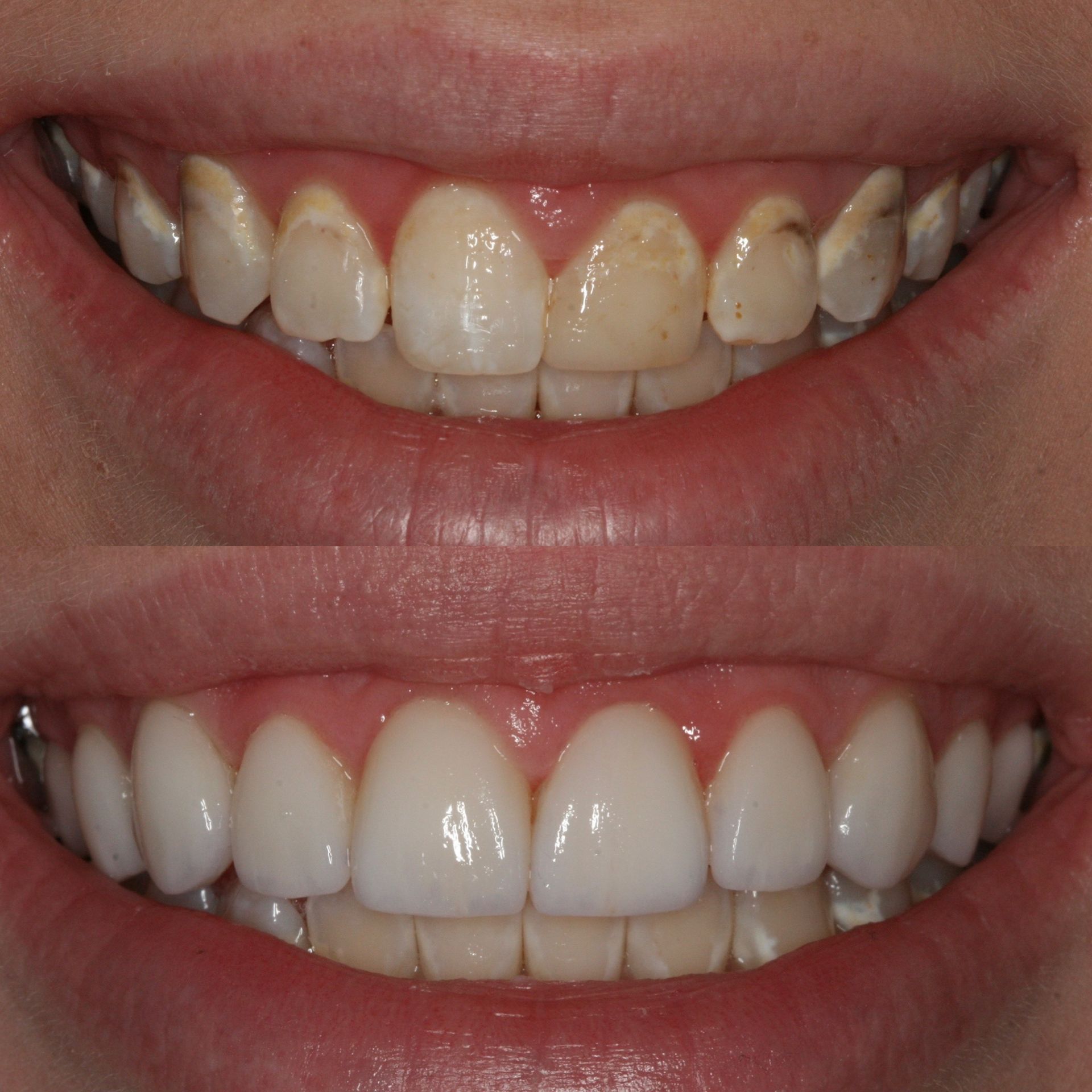 Comparison of teeth before and after cosmetic dental work, showing whiter, aligned teeth.
