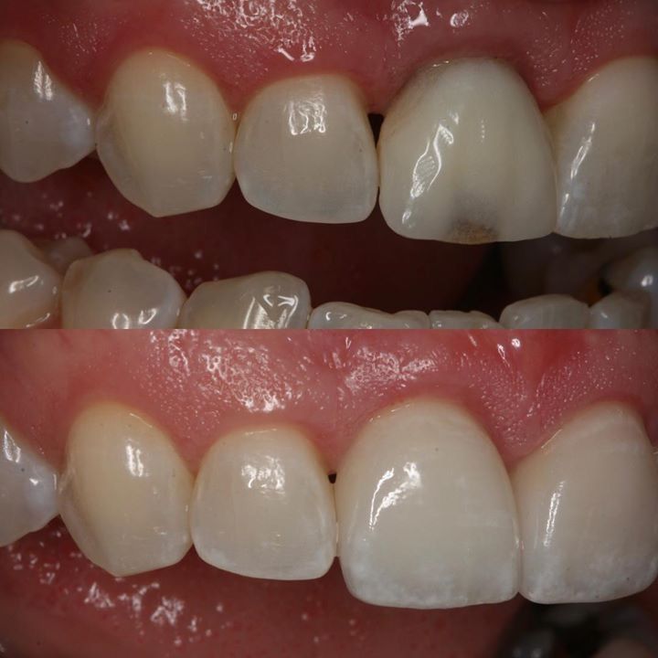 Comparison of teeth before and after dental work, showing a darkened tooth replaced with a white, polished one.
