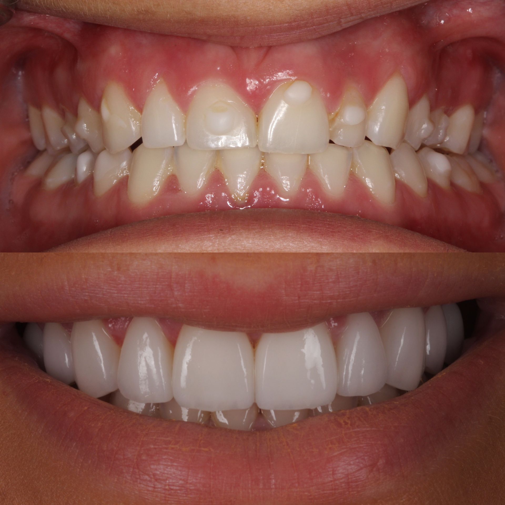 Before-and-after of teeth. Top row shows crooked, discolored teeth. Bottom shows bright, straight, white teeth.