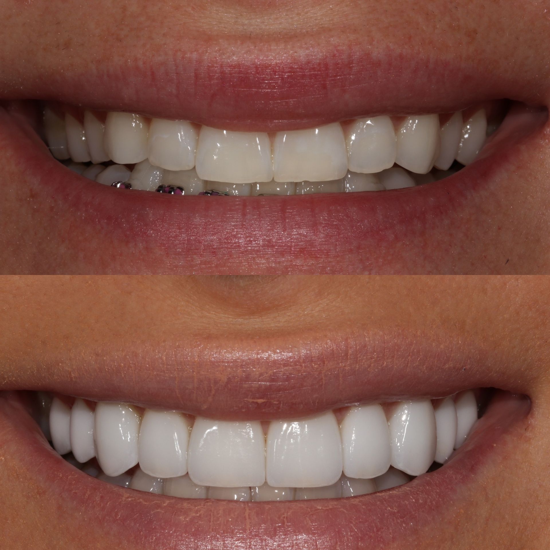 Before-and-after of a smile. Top: teeth before. Bottom: white, straight teeth after cosmetic work.