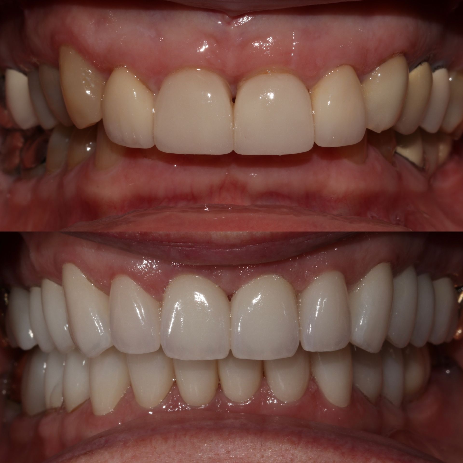 Before and after comparison of a person's teeth. The after shows bright, white teeth and improved symmetry.