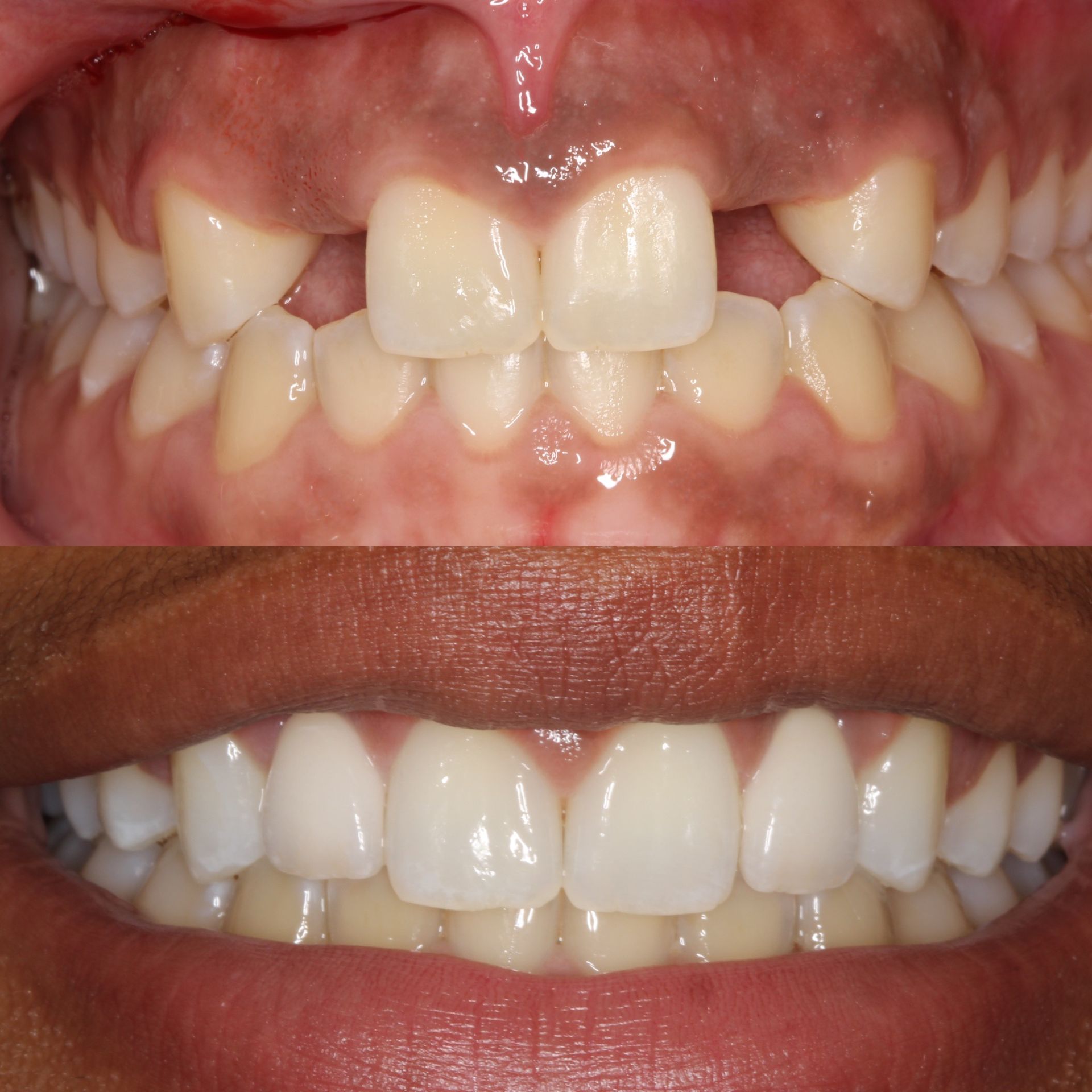 Before and after dental work; the top shows misaligned teeth, the bottom a bright, straight smile.