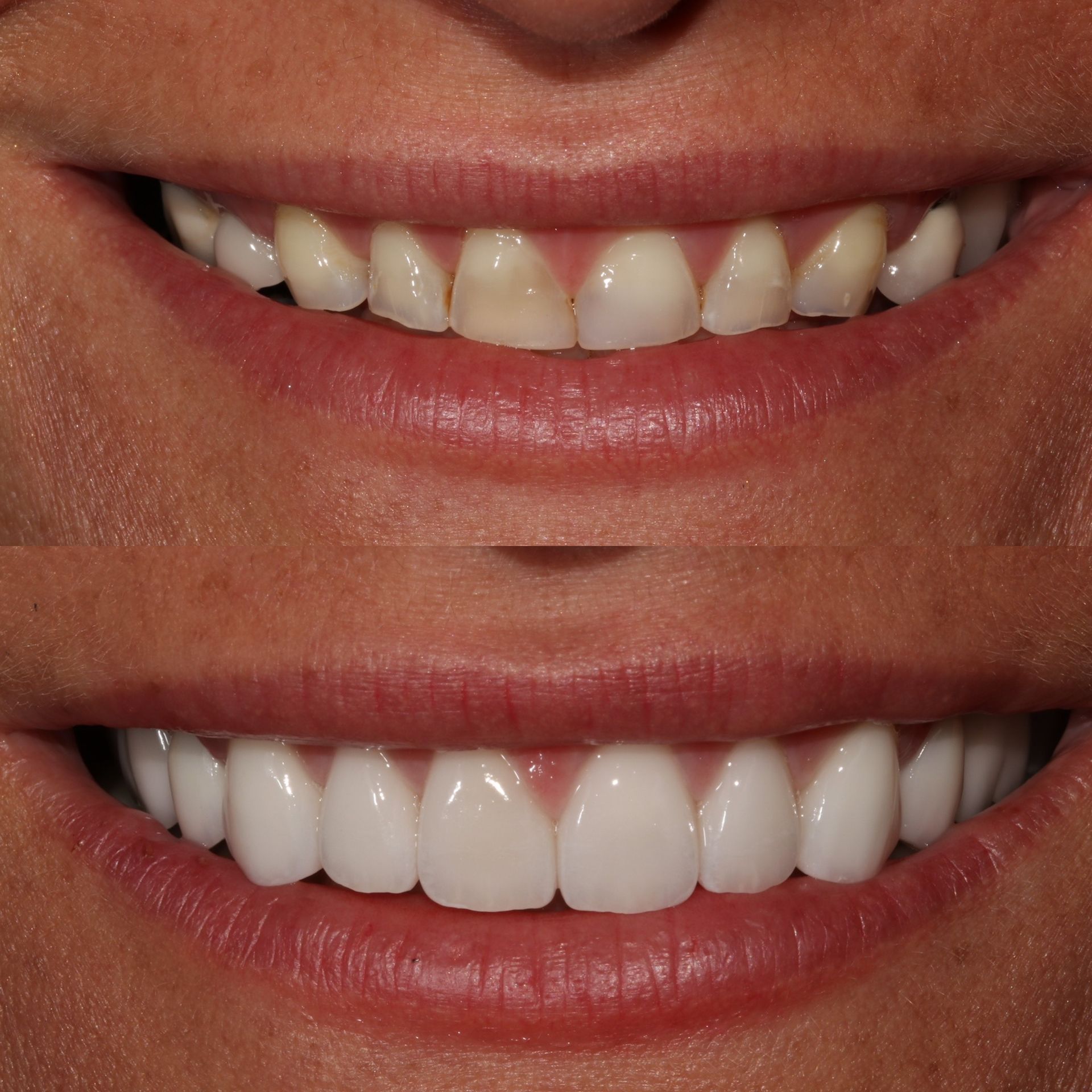 Comparison: top shows stained teeth; bottom shows bright, white teeth after cosmetic dental work.