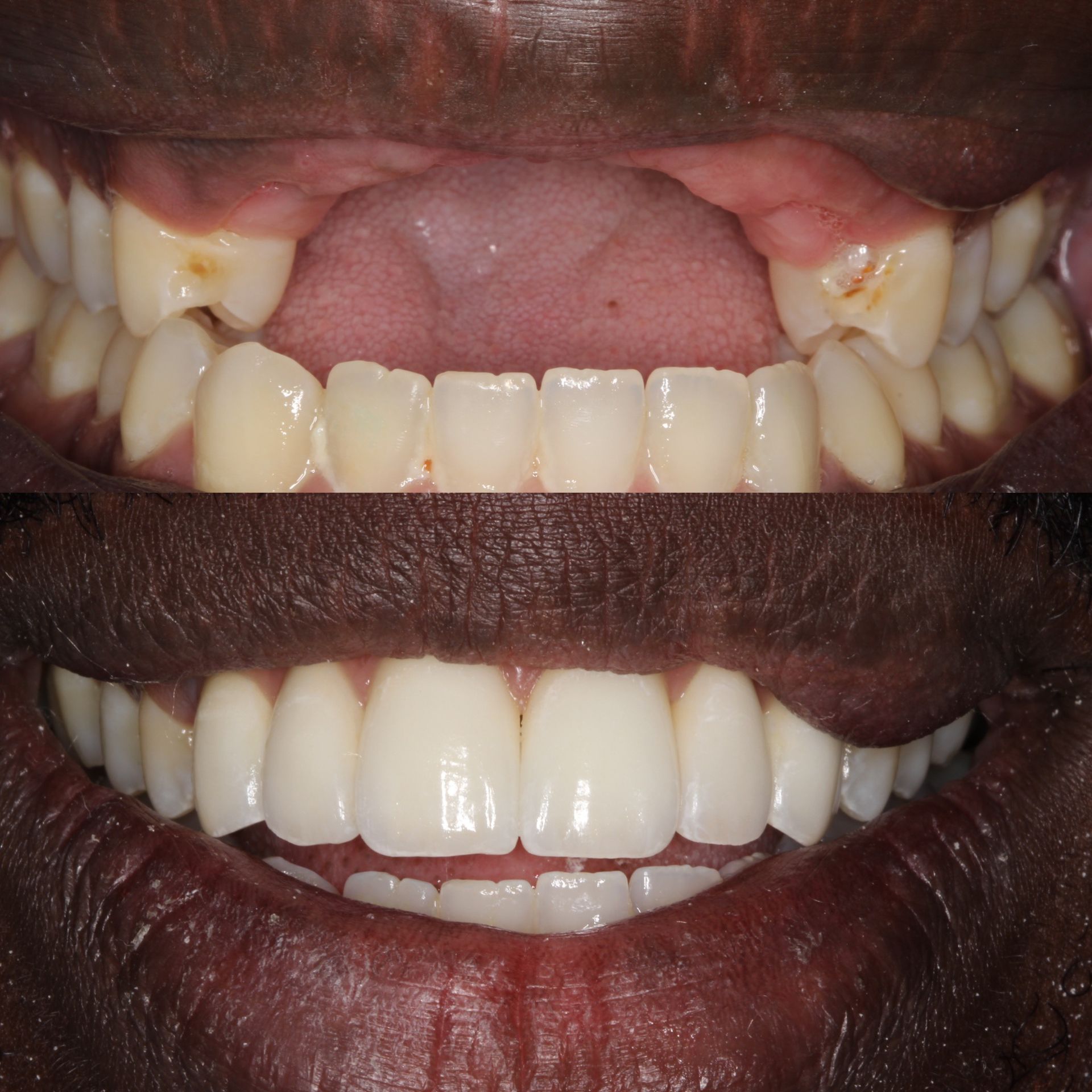 Before and after photos of teeth. The top shows a person's mouth with missing and damaged teeth. The bottom shows new, bright, and aligned teeth.