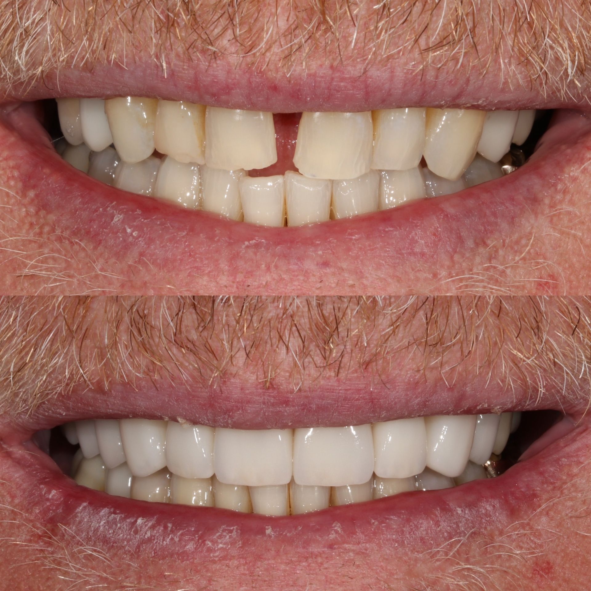 Before-and-after of a person's smile. Top: gap between teeth. Bottom: corrected with matching teeth.