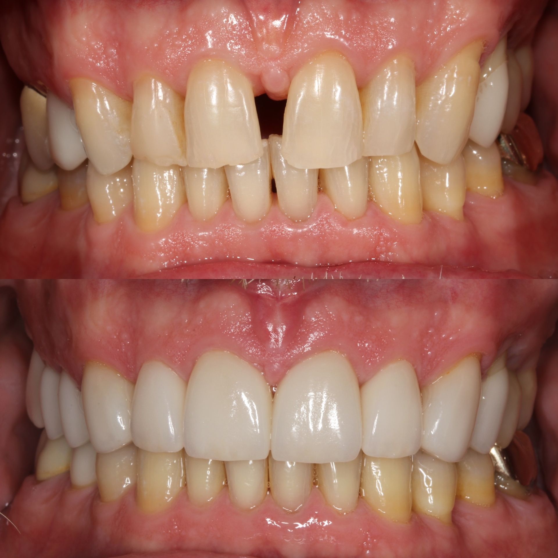 Top: Teeth with gap. Bottom: Teeth after cosmetic dental work, more aligned and white.
