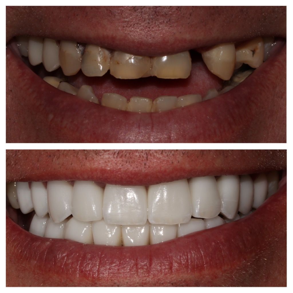 Before and after comparison of a person's teeth; decayed upper teeth replaced with white, straight, and even teeth.