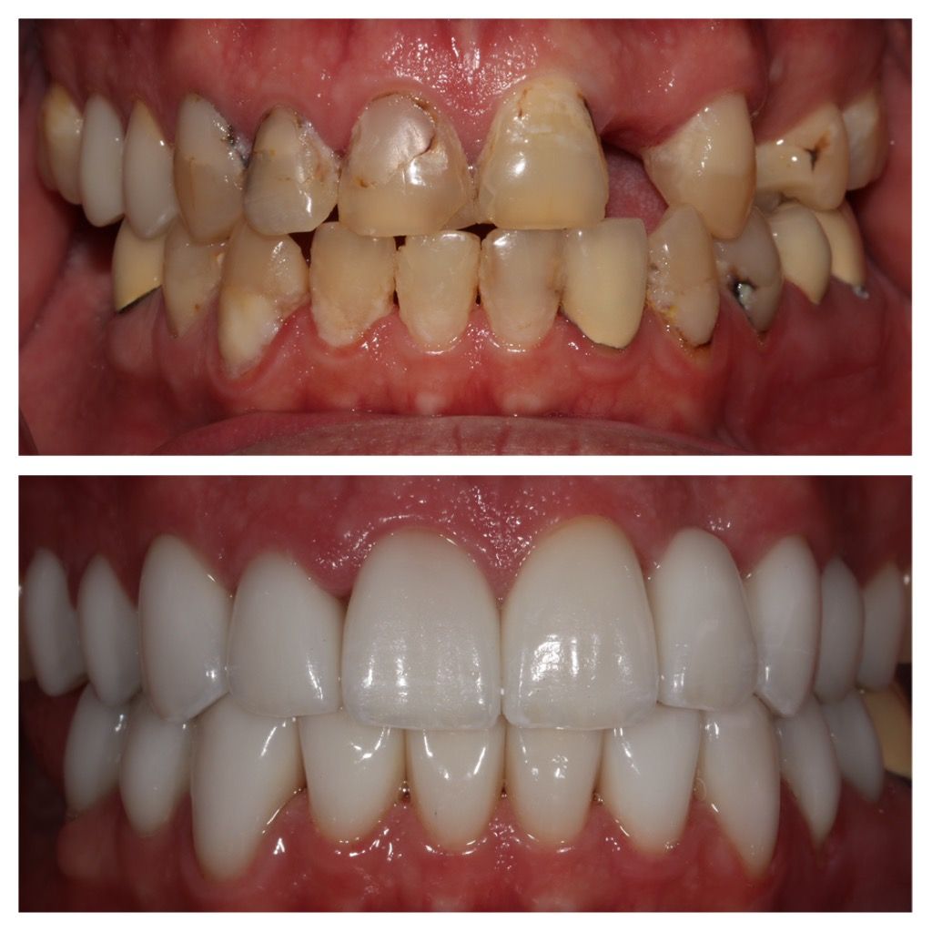 Before and after dental photo: top shows damaged teeth, bottom displays bright, white, aligned teeth.
