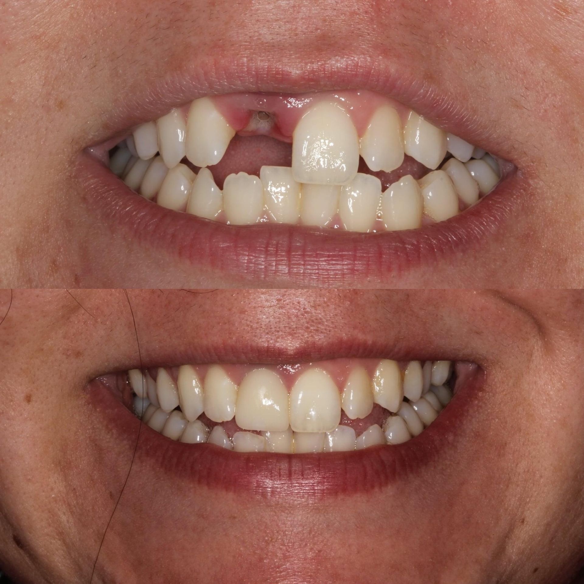 Top: teeth with a missing front tooth. Bottom: same mouth with the tooth replaced, smile.