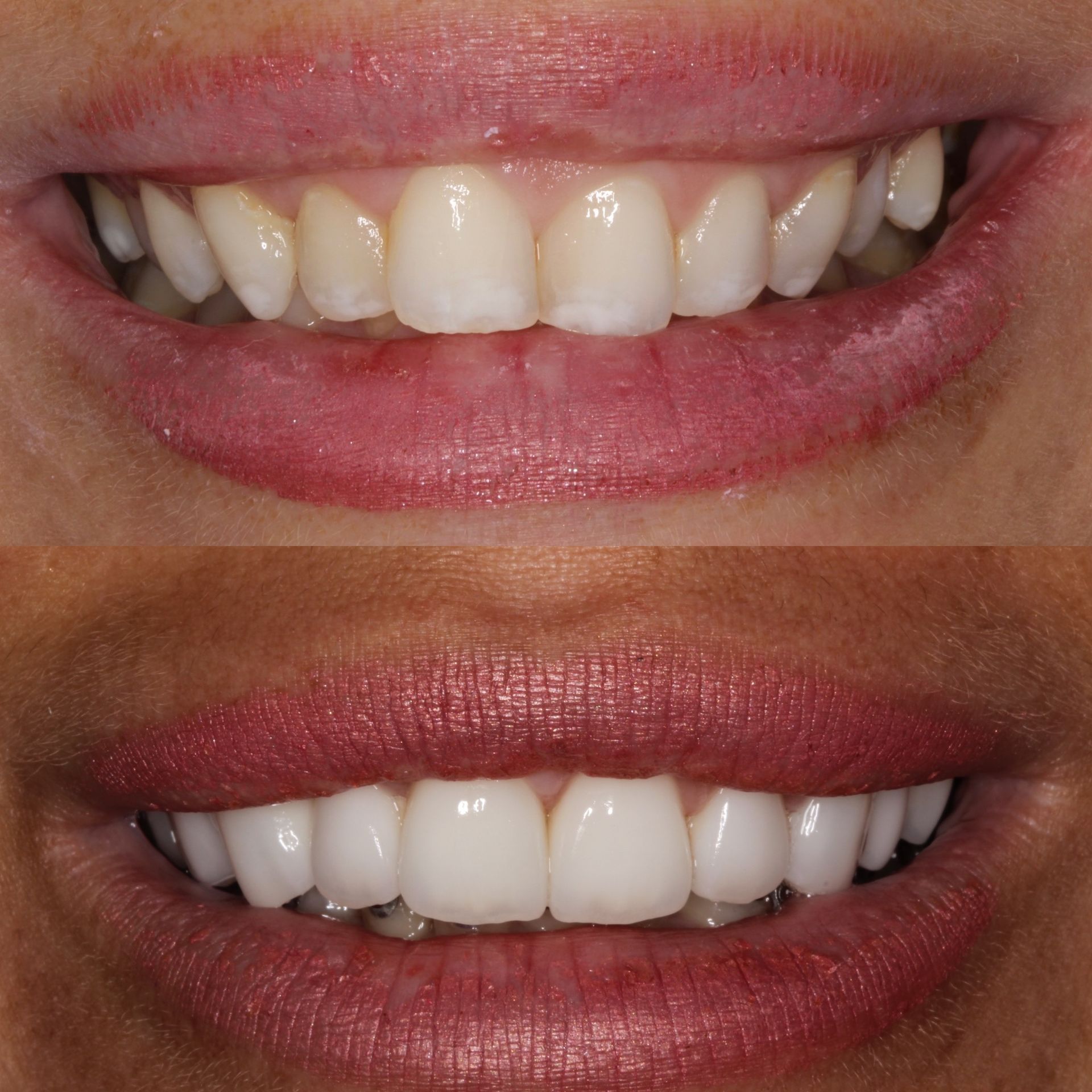 Comparison of two smiles: Before and after cosmetic dental work, showing brighter, whiter teeth.