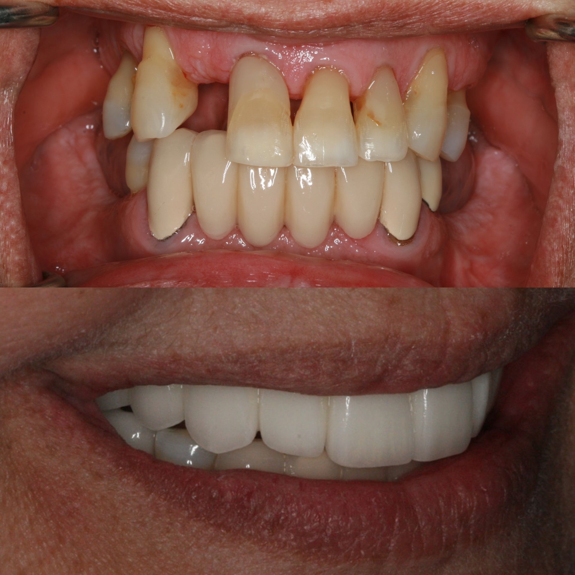 Before and after photos of a person's teeth: damaged upper teeth, then a healthy, bright smile.