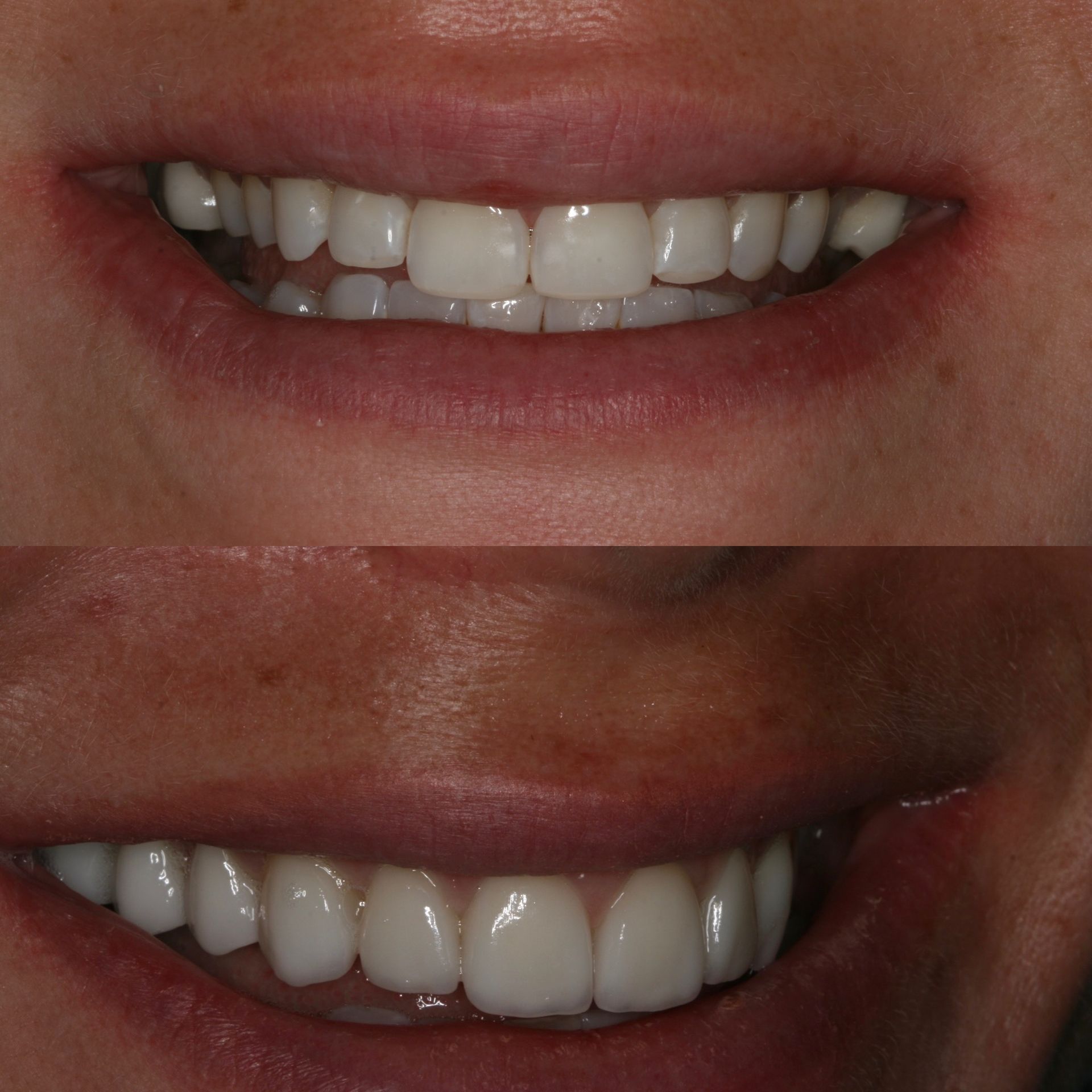 Top: Close-up of teeth with minor imperfections. Bottom: Improved teeth, whiter and more even.