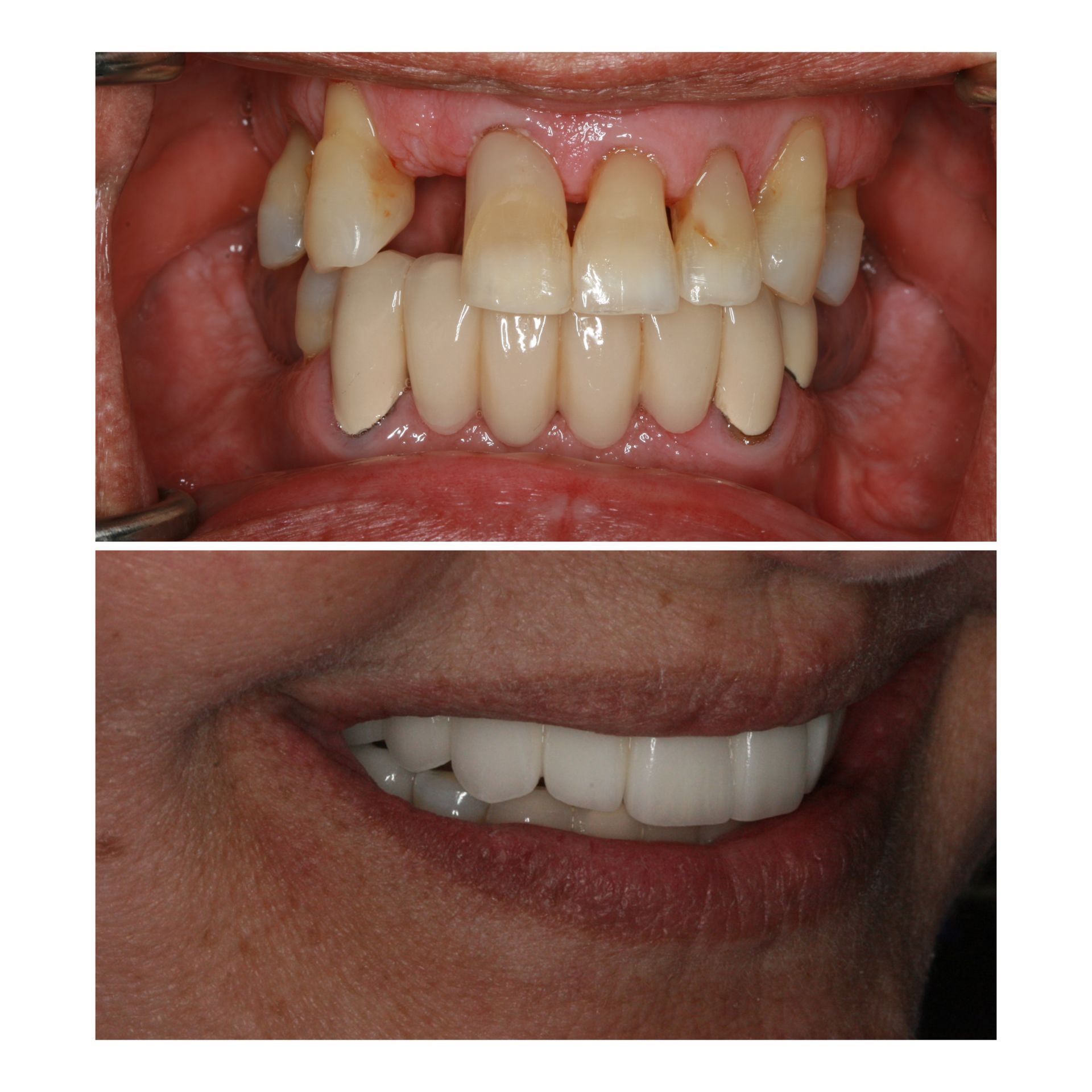 Top: Mouth with missing and damaged teeth. Bottom: Smiling mouth with new teeth.