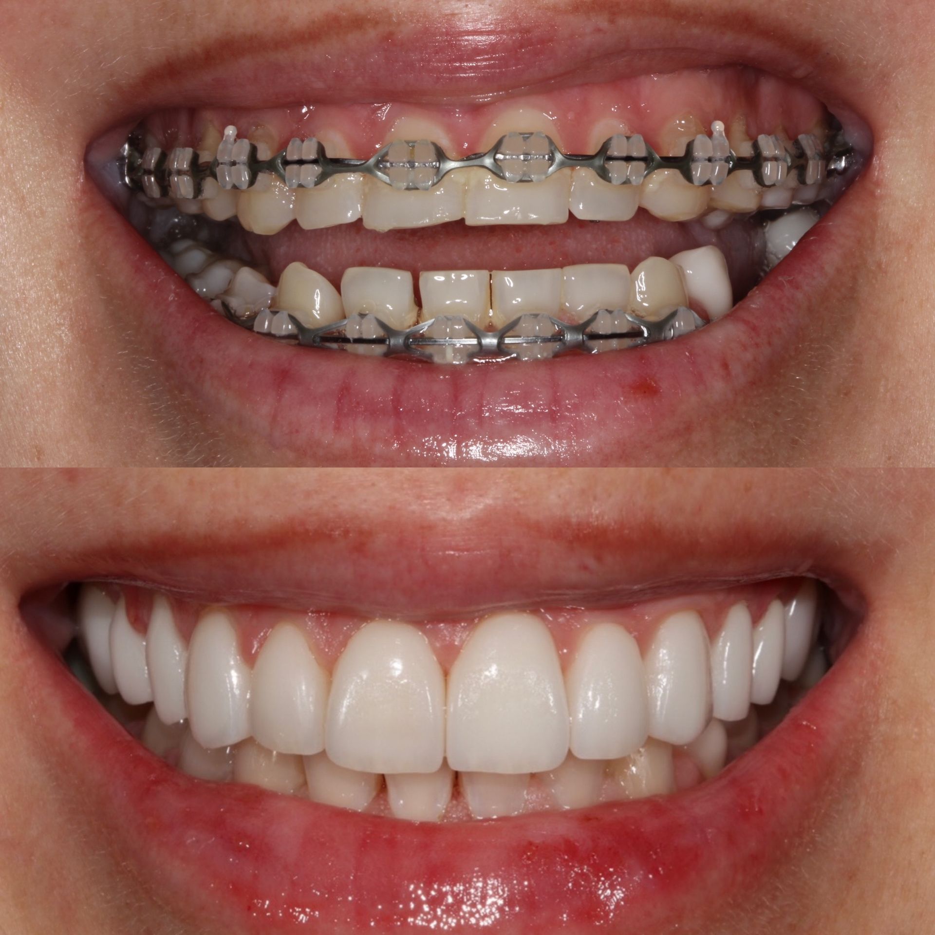 Top: Teeth with metal braces. Bottom: Smile with straight, white teeth.