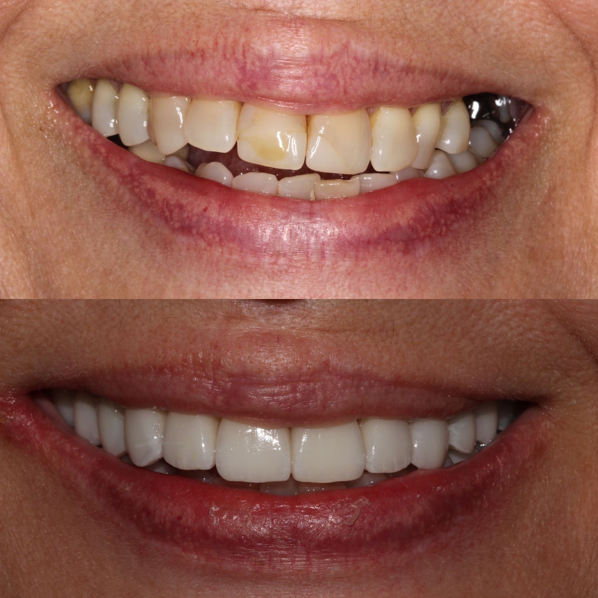 Comparison of teeth before and after dental work, showing stained teeth versus a bright, white smile.