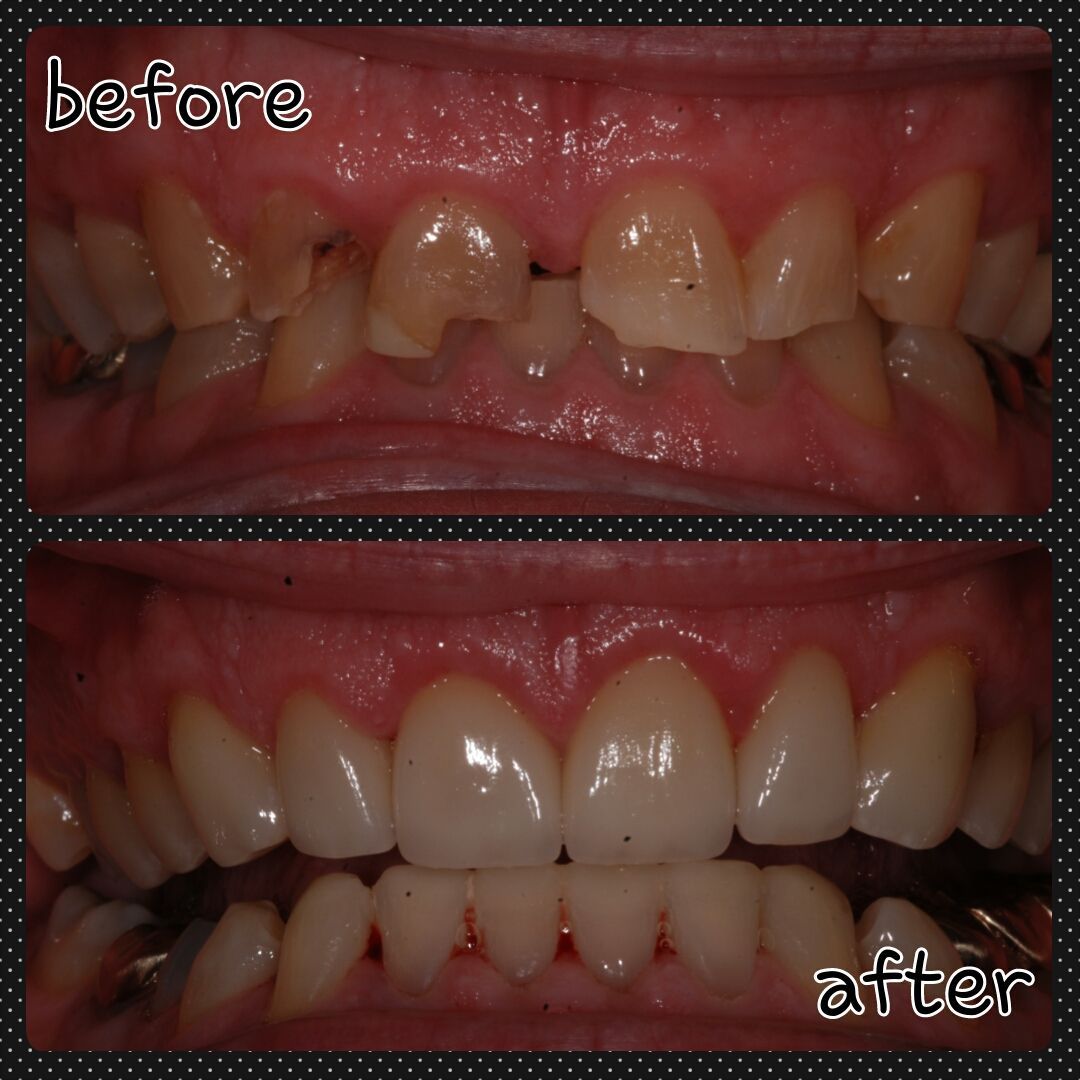 Comparison of teeth before and after dental work, showing chipped and discolored teeth in 