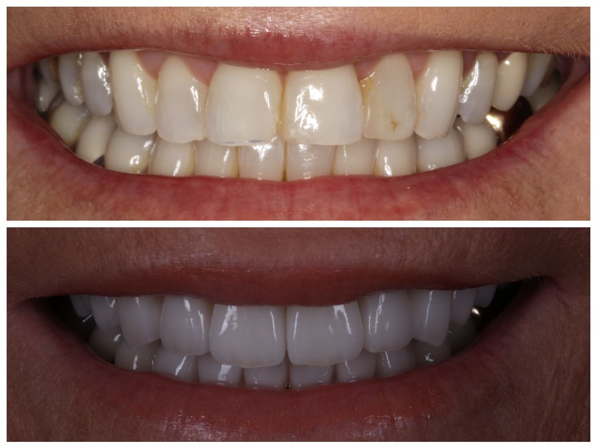 Top: Smile showing stained teeth. Bottom: Smile showing whitened teeth.