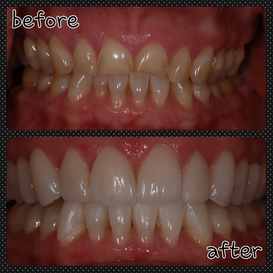 Side-by-side comparison of teeth. Top: stained teeth, bottom: bright white teeth after a cosmetic dental procedure.