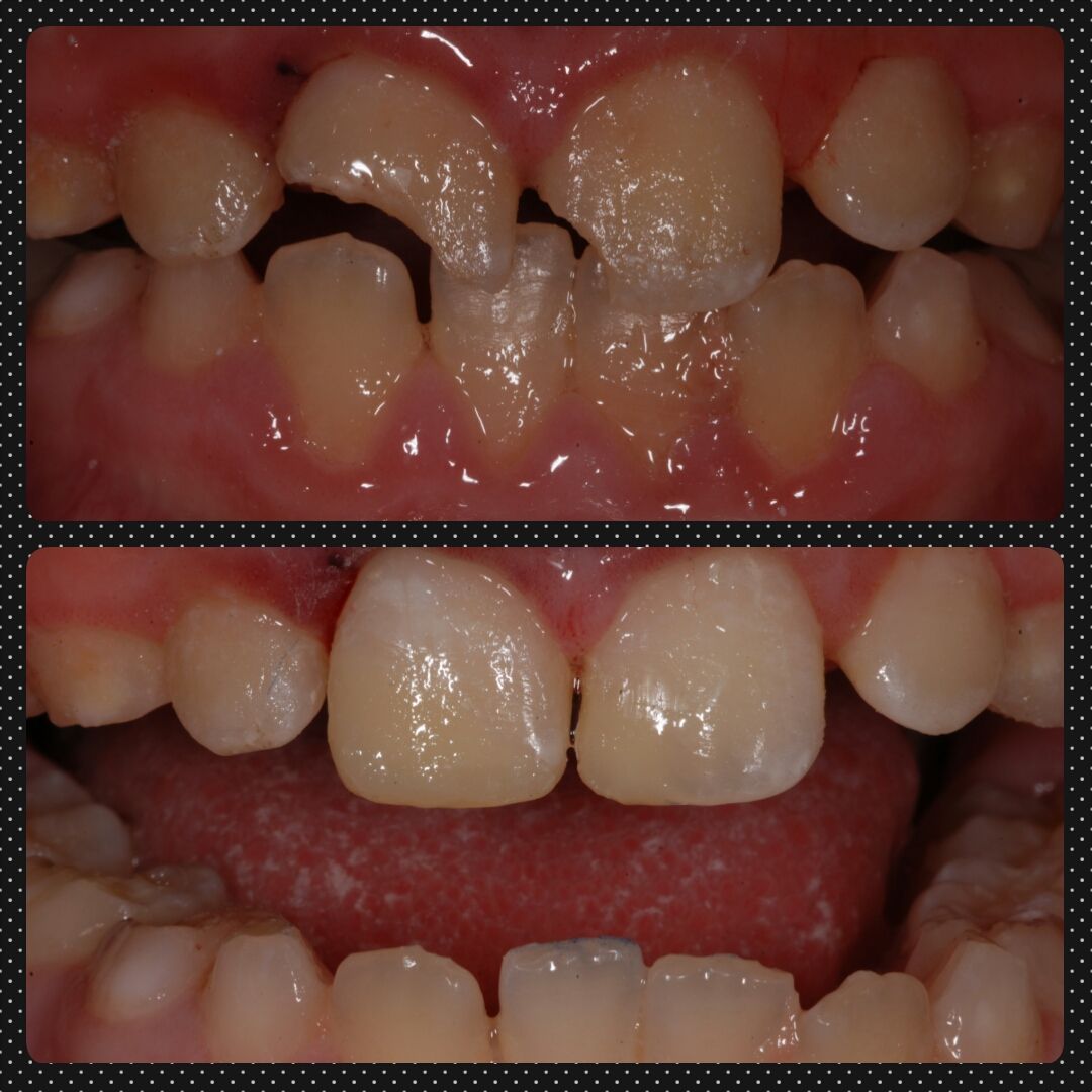 Damaged front teeth repaired with white composite fillings, before and after view.
