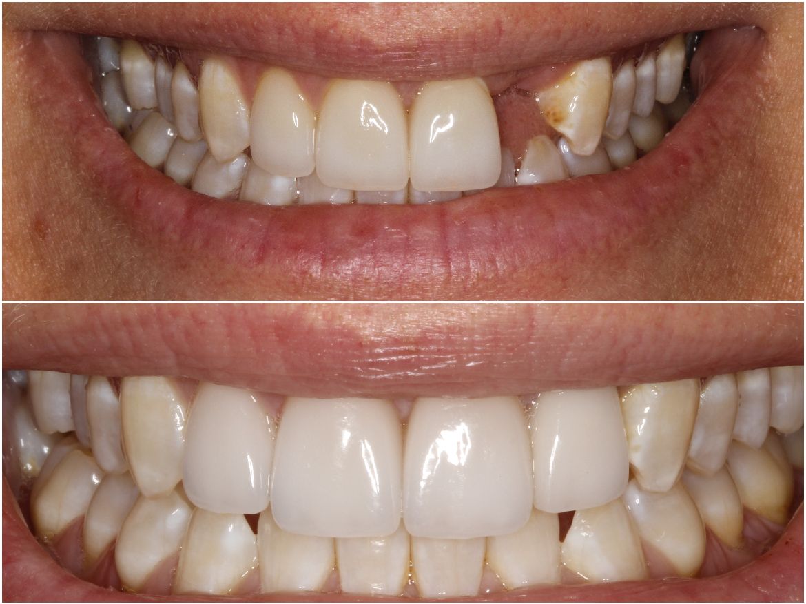 Top: Teeth with a missing front tooth. Bottom: Teeth after cosmetic dentistry, fully restored.