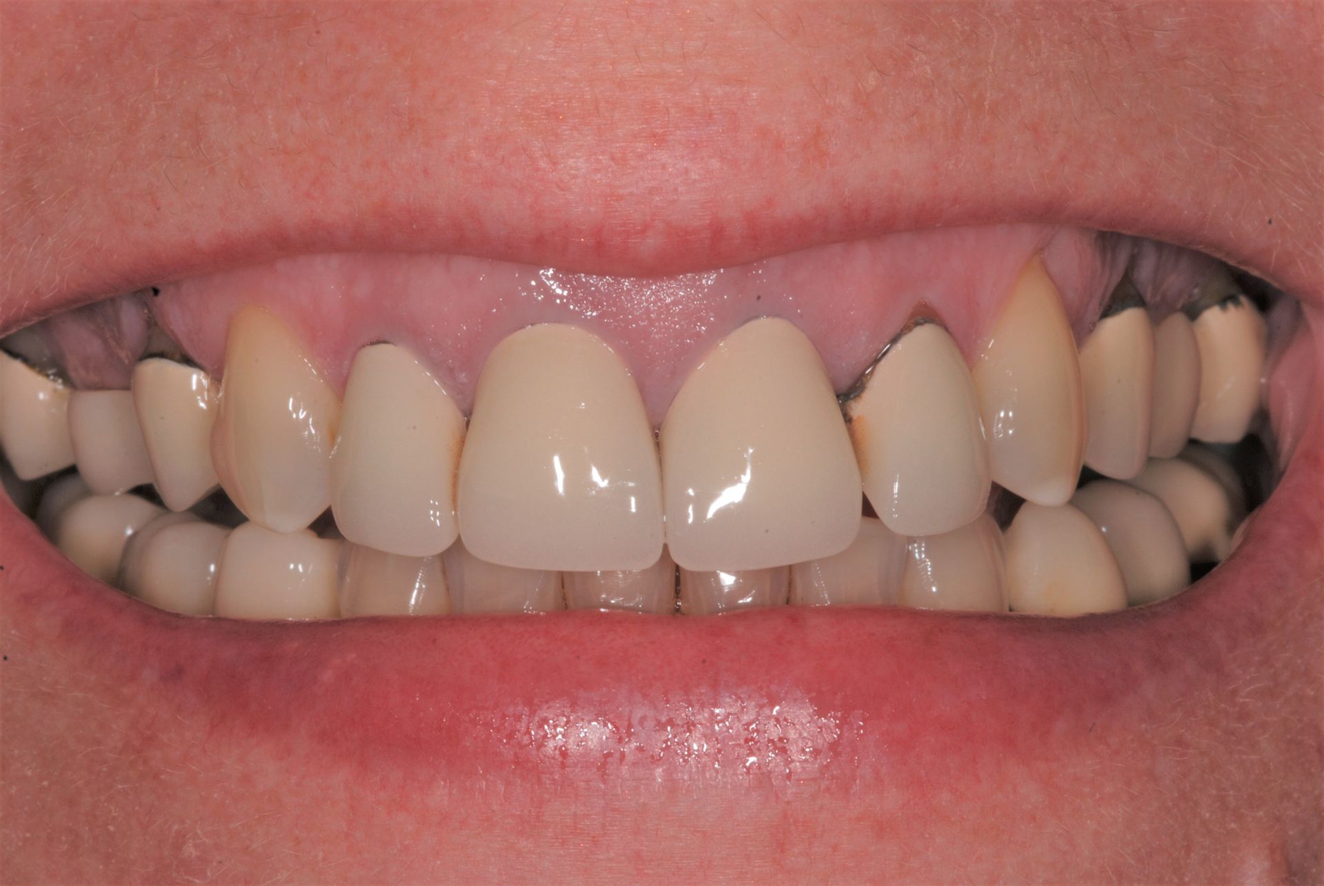 Close-up of a person's teeth showing dental work and some discoloration.