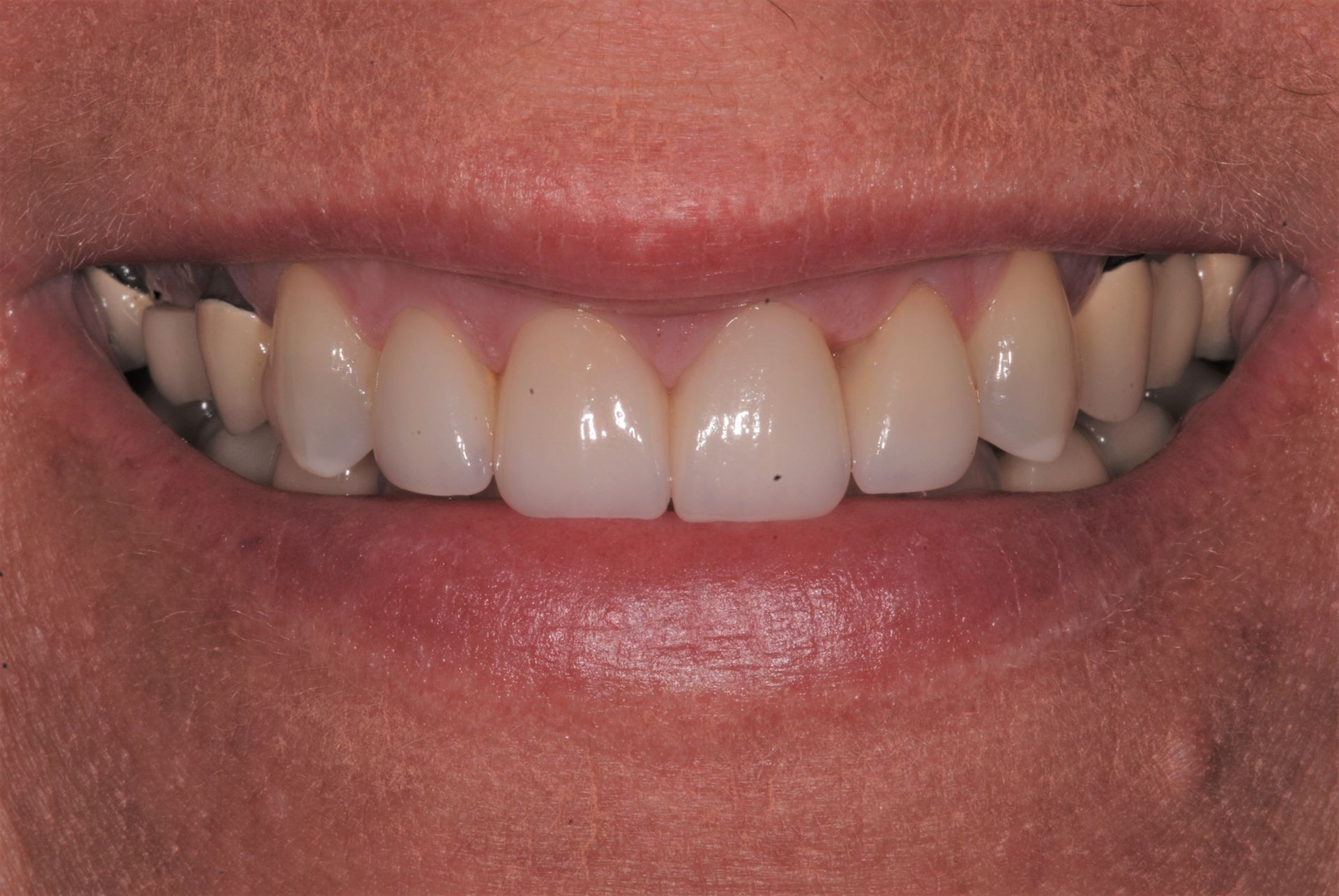 Close-up of a person's smiling mouth showing a row of white teeth, lips are pink, and skin is light.