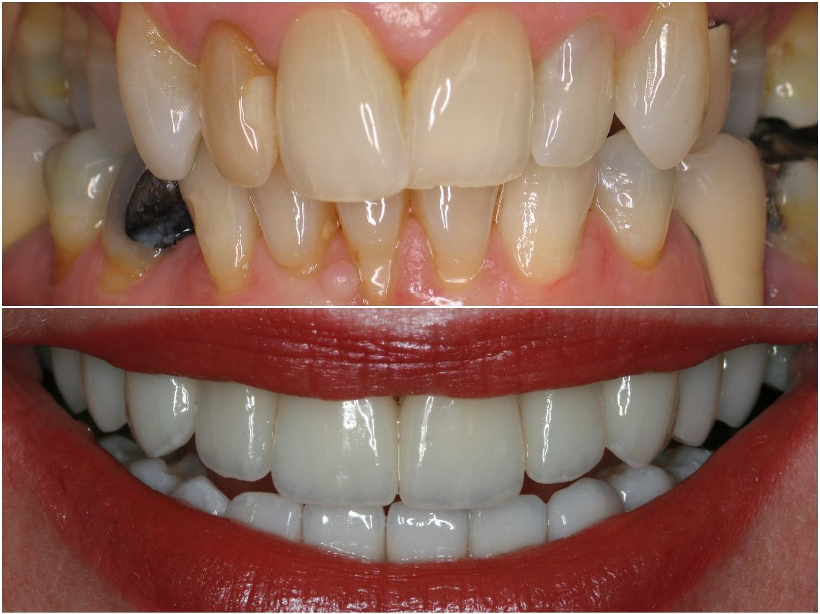 Before and after dental work: top shows worn, stained teeth; bottom reveals bright, even, white smile.