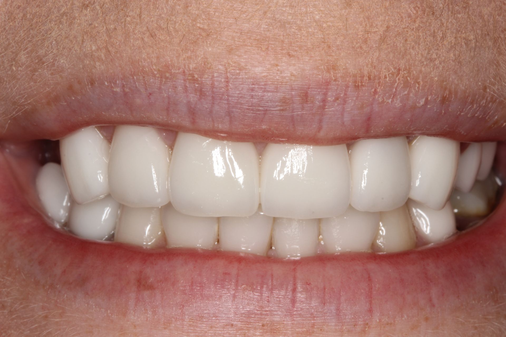 Close-up of a person's bright, white teeth and pink gums. They are smiling, showing their upper and lower teeth.