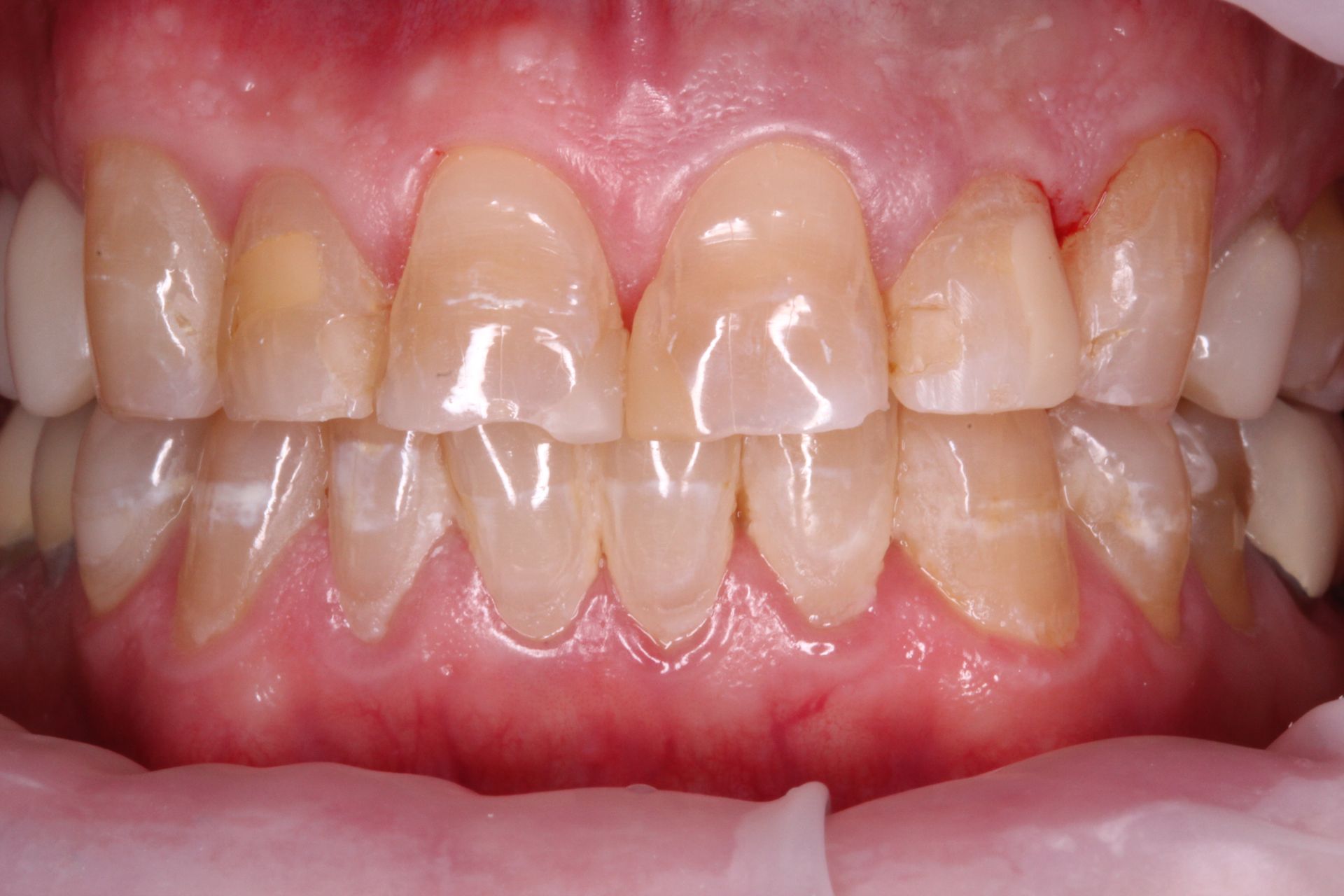 Close-up of teeth, displaying slight discoloration with visible surface texture against pink gums.