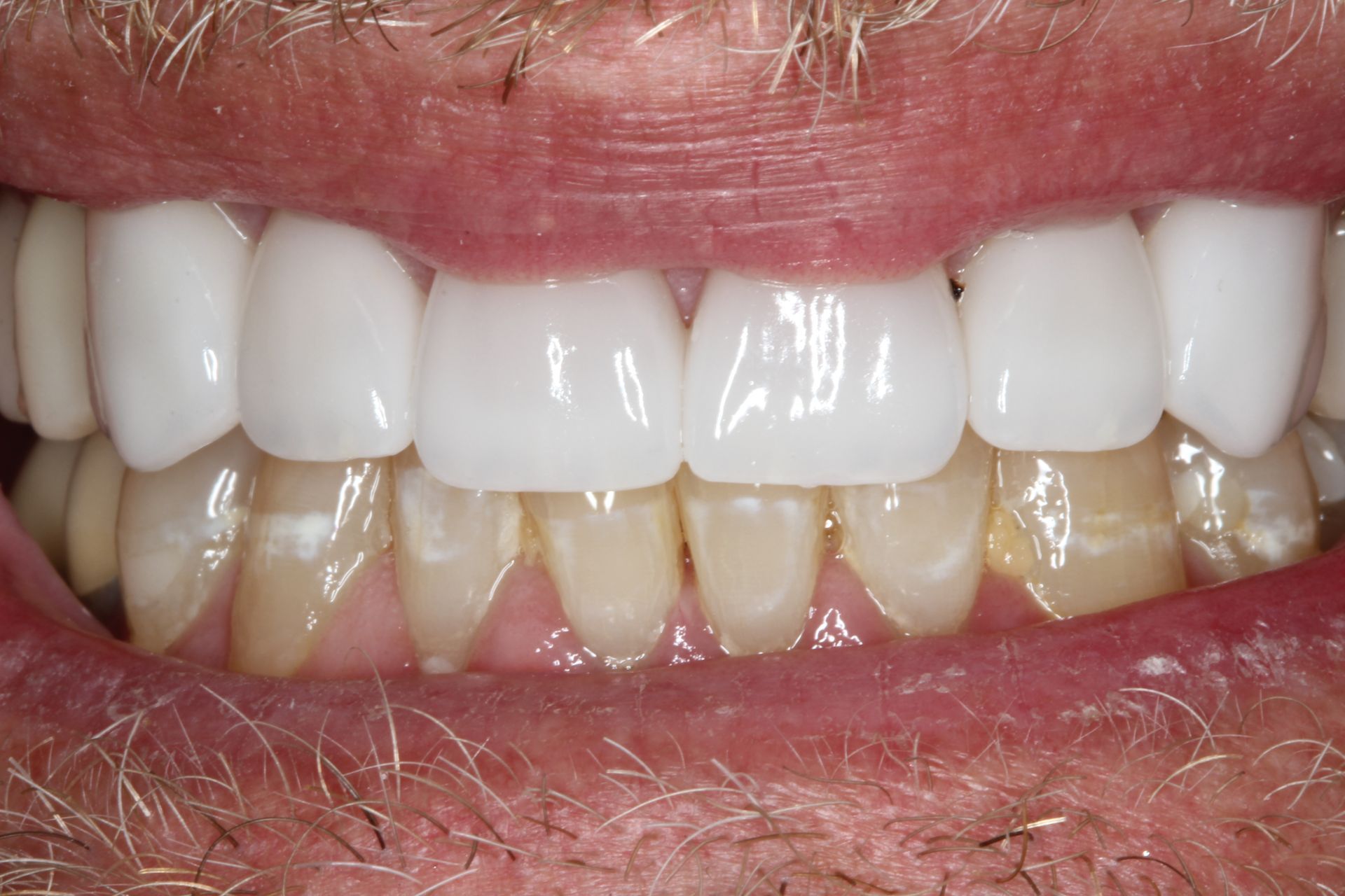 Close-up of a person's mouth, showing bright white upper teeth contrasting with yellowed lower teeth.