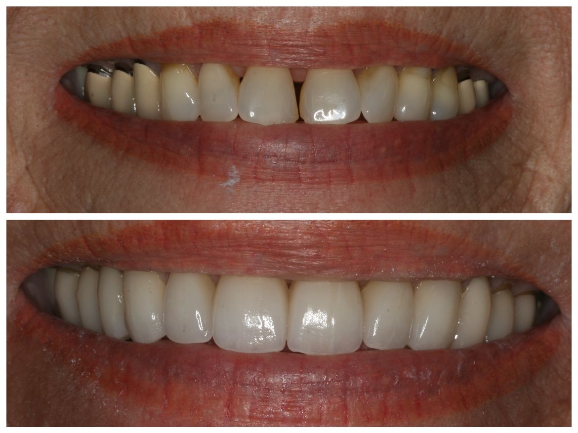 Top: Woman's teeth with gaps, discolored. Bottom: Replaced teeth, white and aligned, creating a smile.
