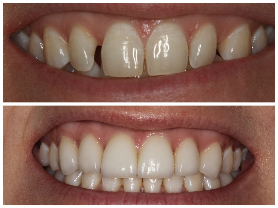 Before-and-after of teeth. Top: crooked teeth with gap. Bottom: straight, white teeth.